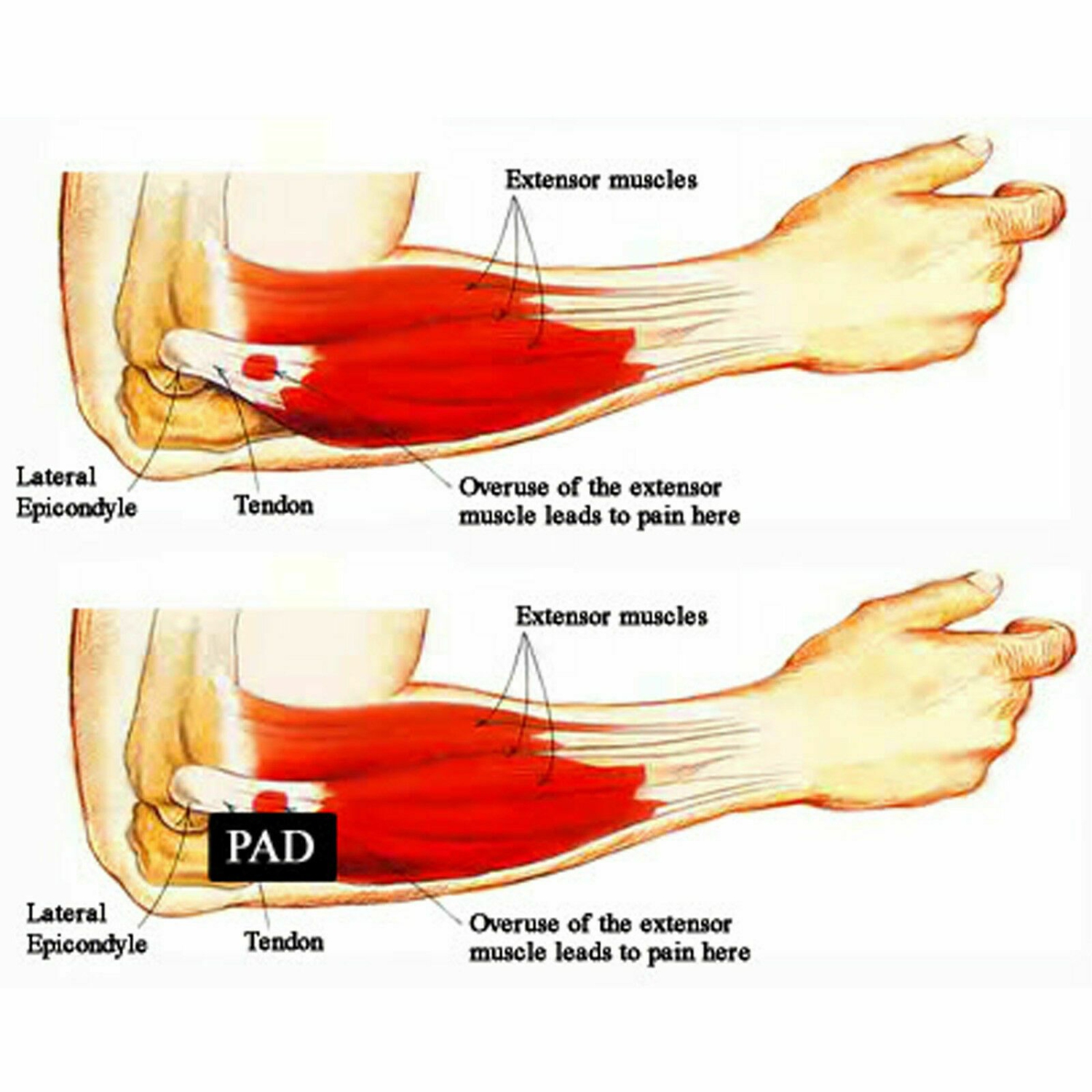 Breathable Elbow Brace Targeted Compression for Elbow Pain Gel Band Pain Relief