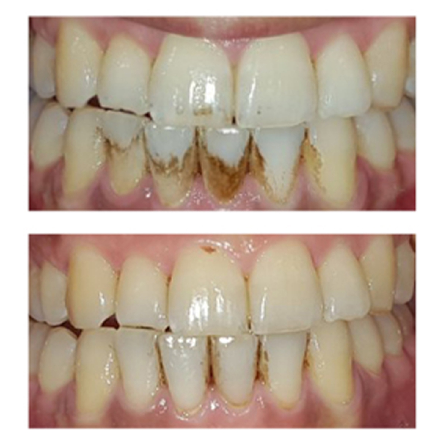 ToothWave by Silk'n DentalRF Technology Toothbrush