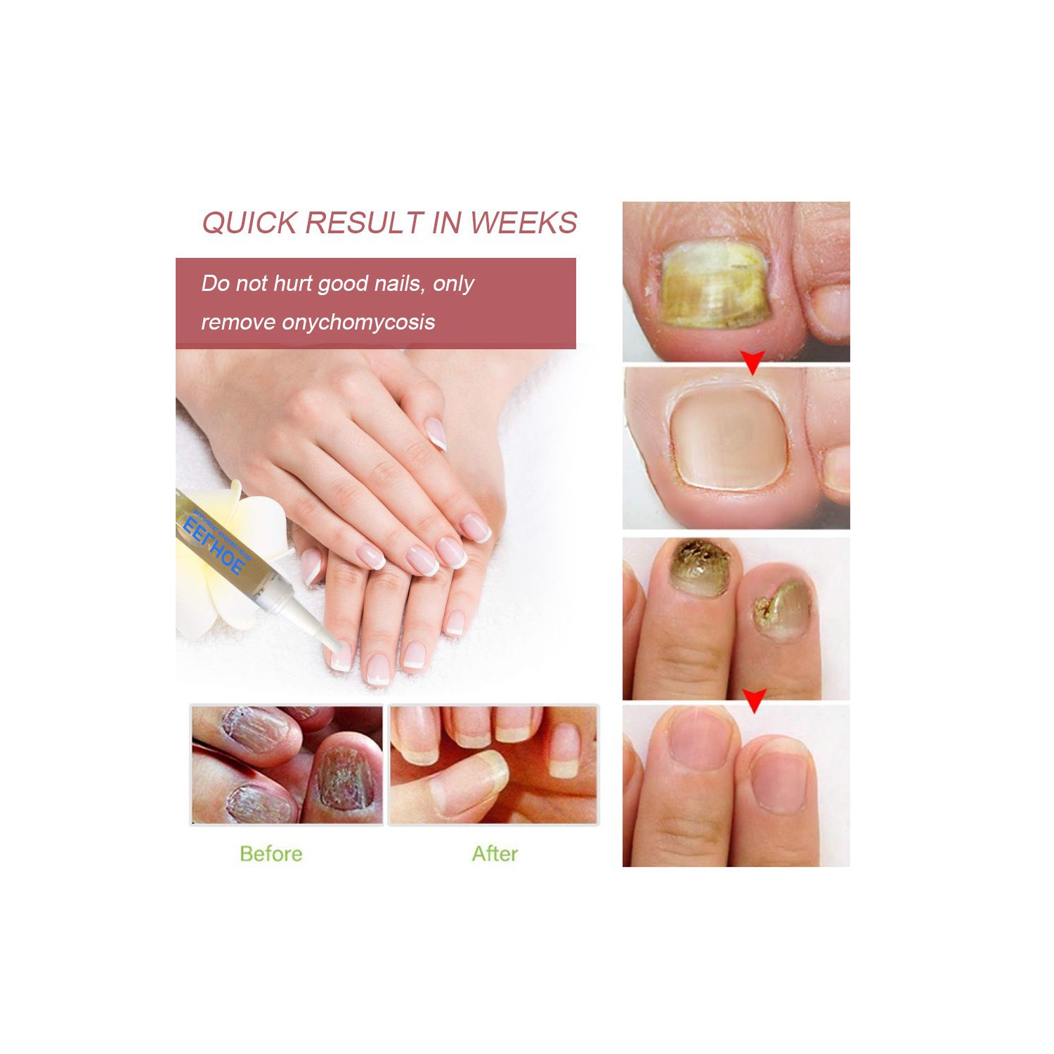 Anti-fungal Home Treatment Set Toe Nail Treatment Pen Onychomycosis Paronychia Anti Fungal Fungus Care Repair Serum Kit