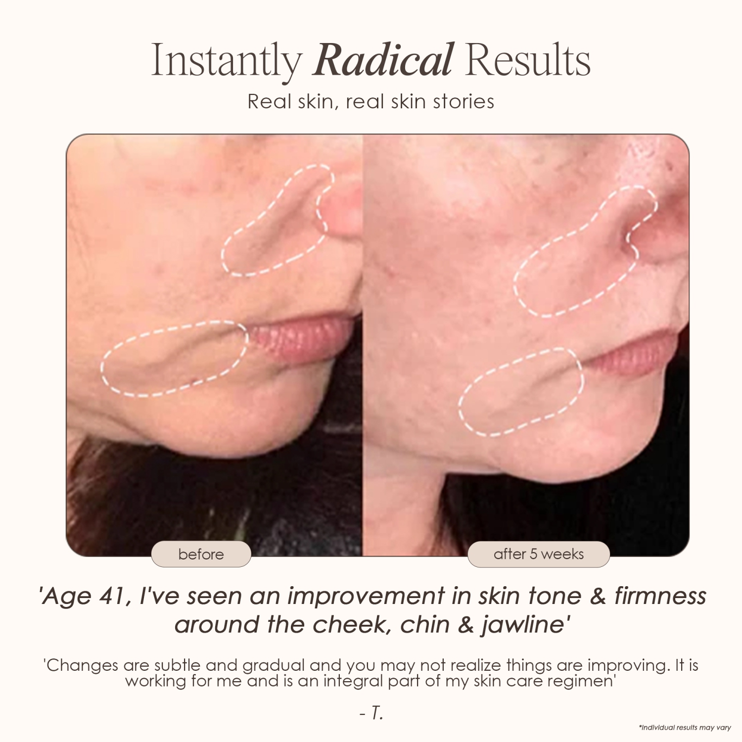 Project E Beauty SkinSonic | LED Ultrasonic Wand | Red, Blue & Green LED Light Therapy | Collagen Boost | Anti-Aging