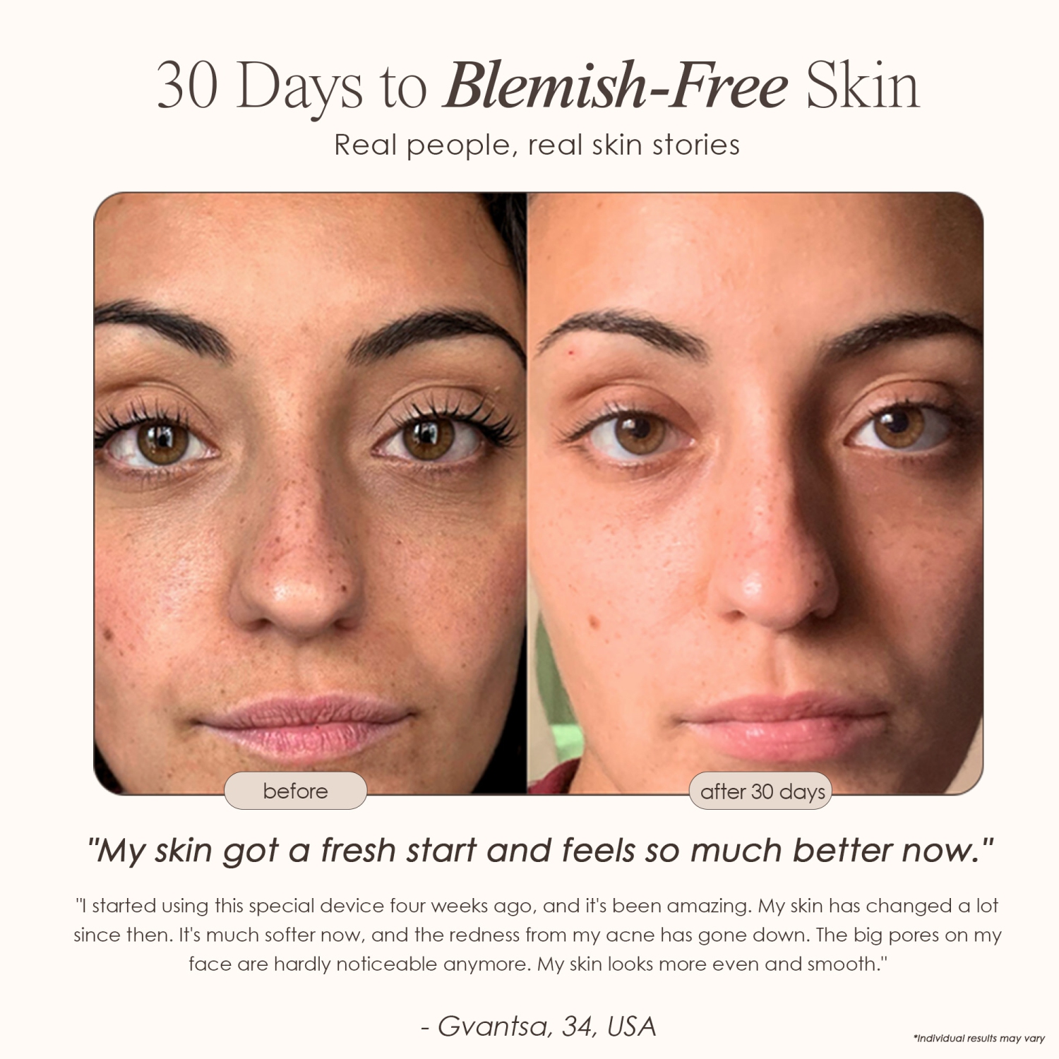 Project E Beauty Reinvo Facial Microdermabrasion Wand | Skin Renewal | Reduce Fine Lines & Wrinkles | Treat Sun Damage