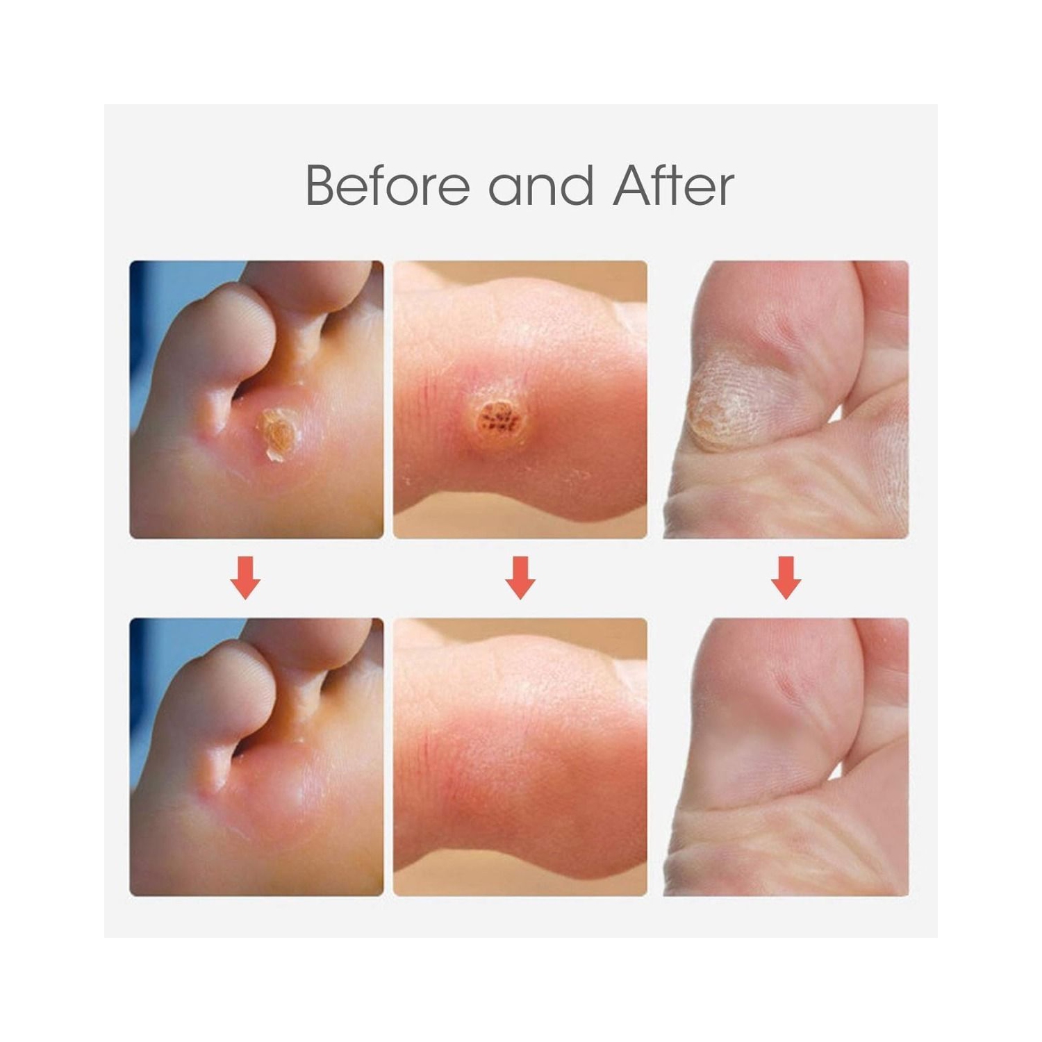 6Pcs Corn Remover Pads With tool