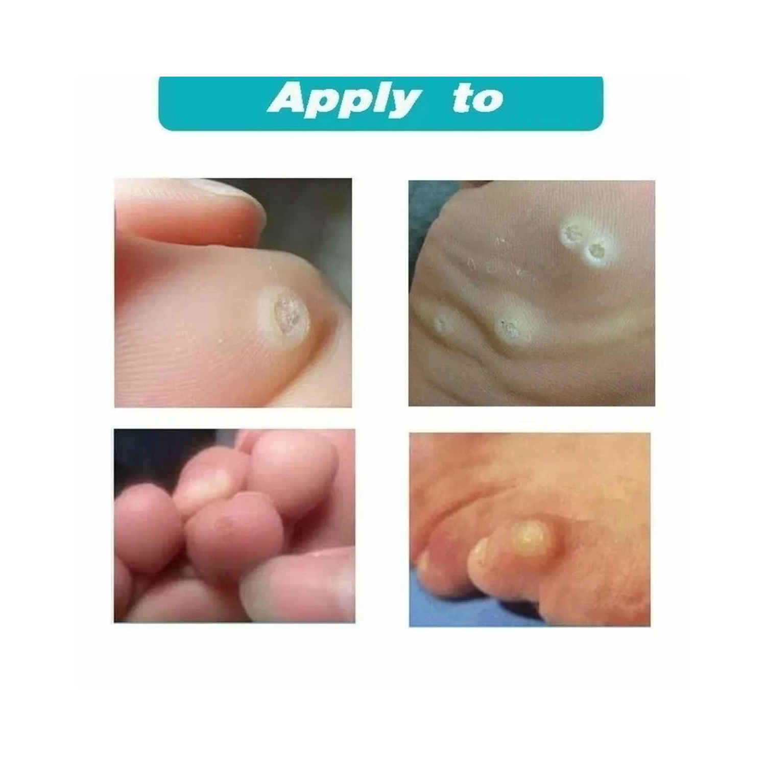 6Pcs Corn Remover Pads With tool