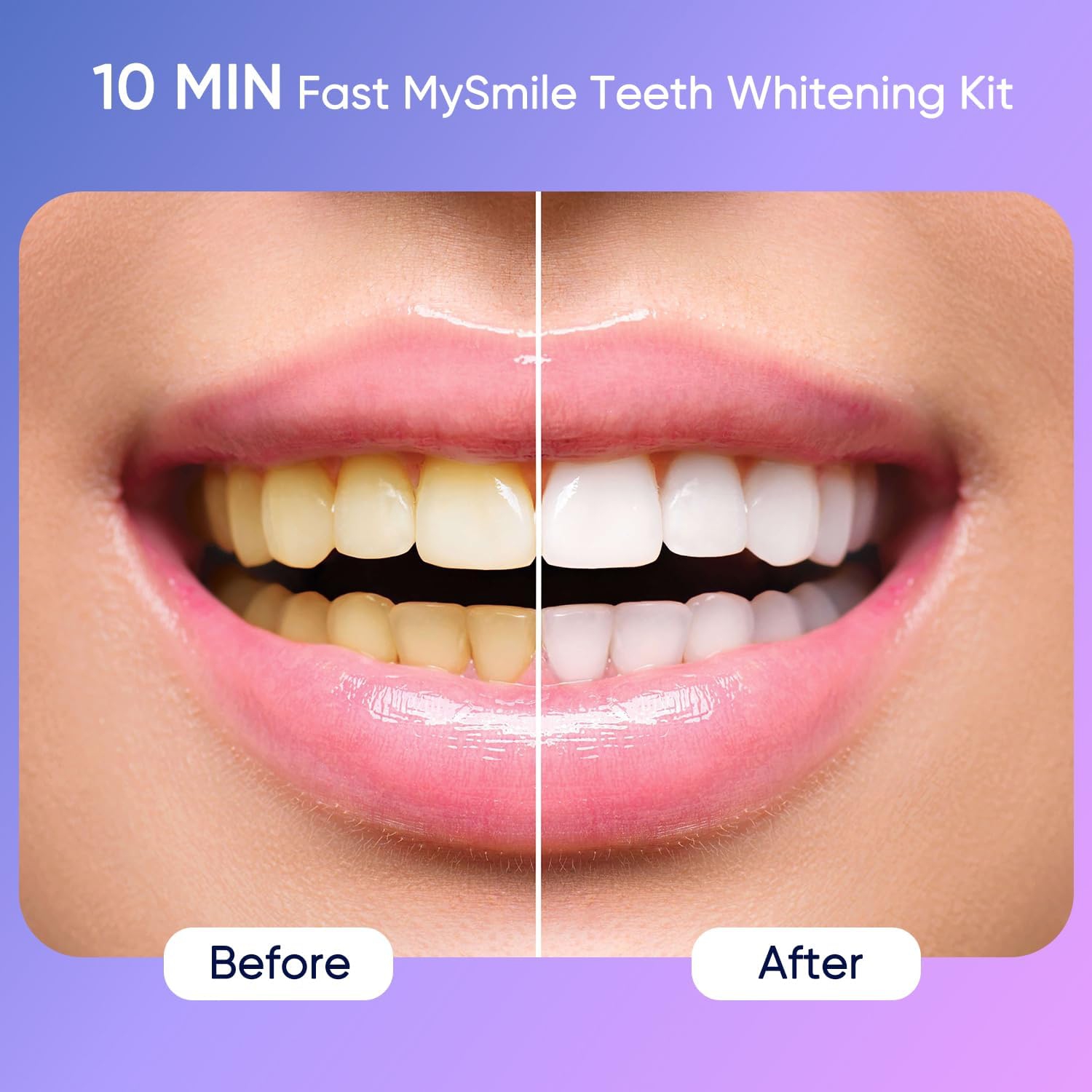 MySmile Deluxe 10 Min Teeth Whitening Kit with 28 LED Light, 35% Carbamide Peroxide Teeth Whitening Gel, Helps Remove Years of Stains from Coffee,