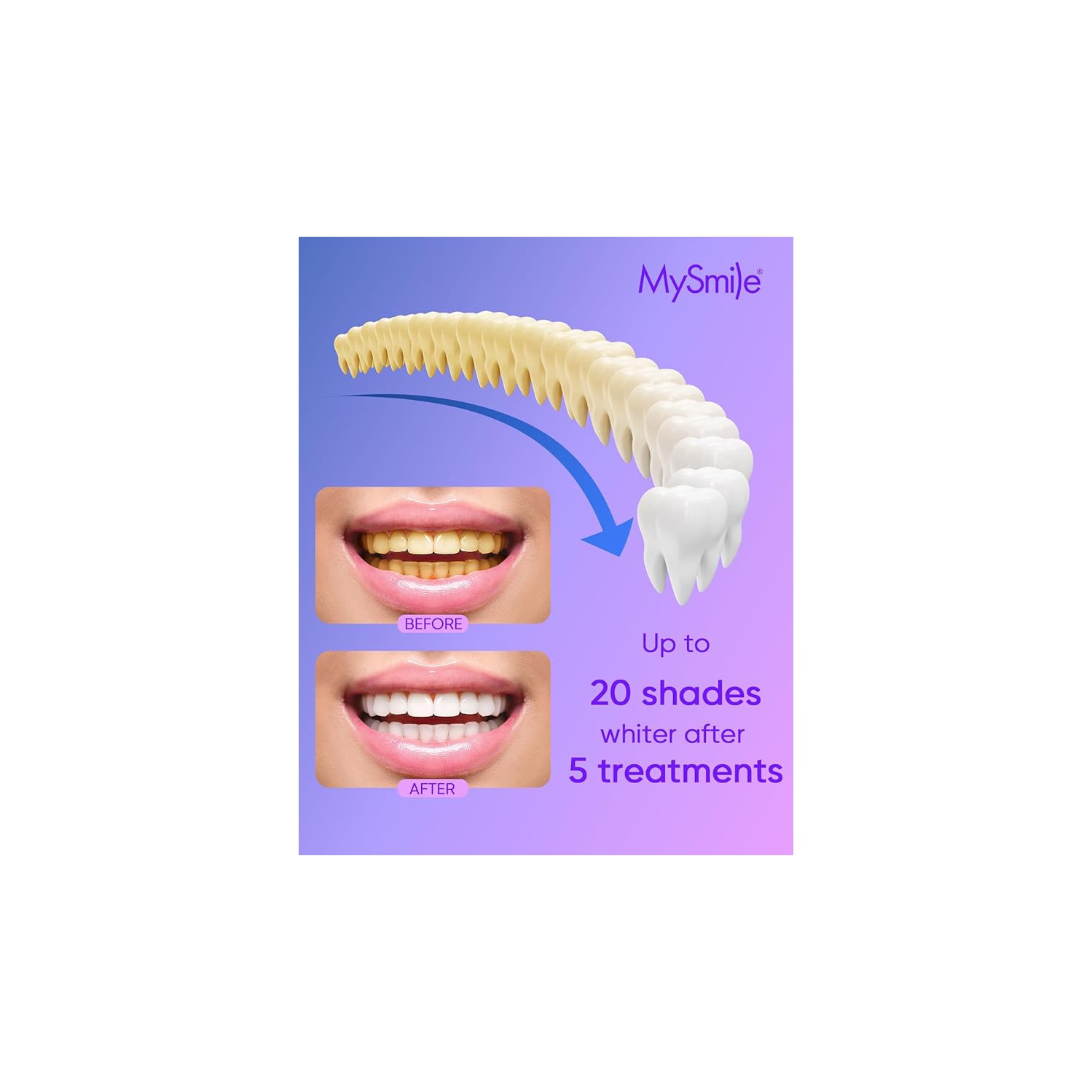 MySmile 4Pcs 35% Non-Sensitive Teeth Whitening Gel Refill Pack Kit- Effective Painless Carbamide Peroxide Enamel Safety Mint Flavor Teeth Whitener