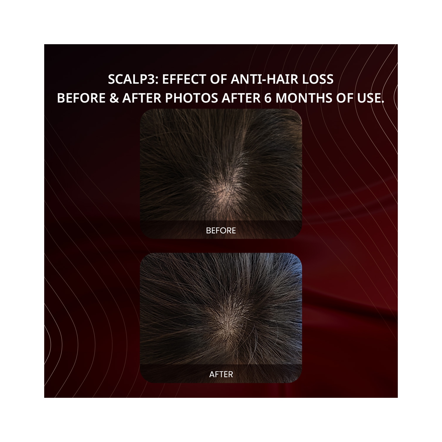 Breo Scalp3 Scalp Massager Comb Anti Hair Loss Scalp Massaging brush Hair Growth Care Scalp Hair Therapy Scalp Reduction Redlight Infrared Therapy