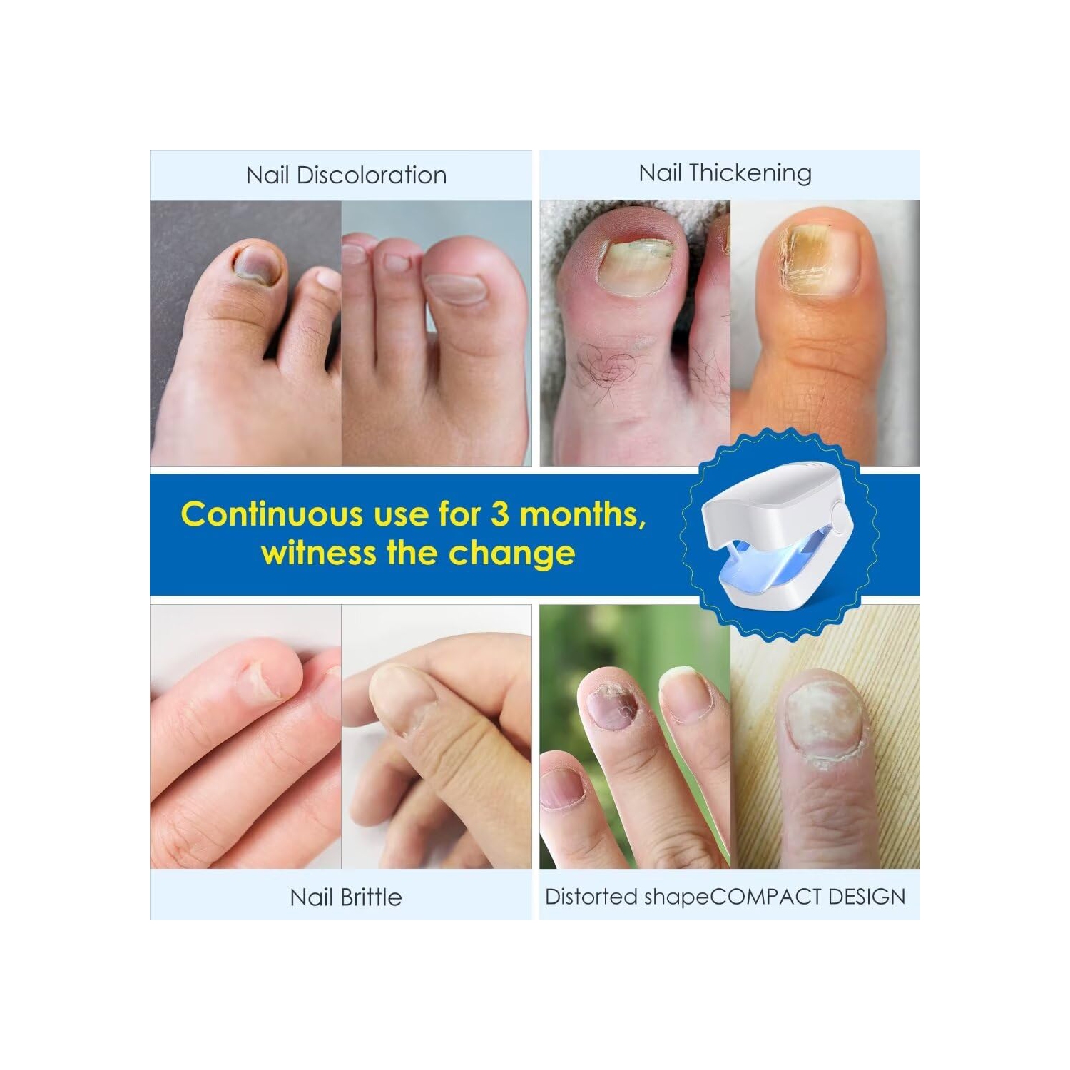 Dispositif de nettoyage de la lumière pour onychomycose, Clou Fungus Light pour ongles des ongles des ongles, Dissolvant de champignons pour ongles