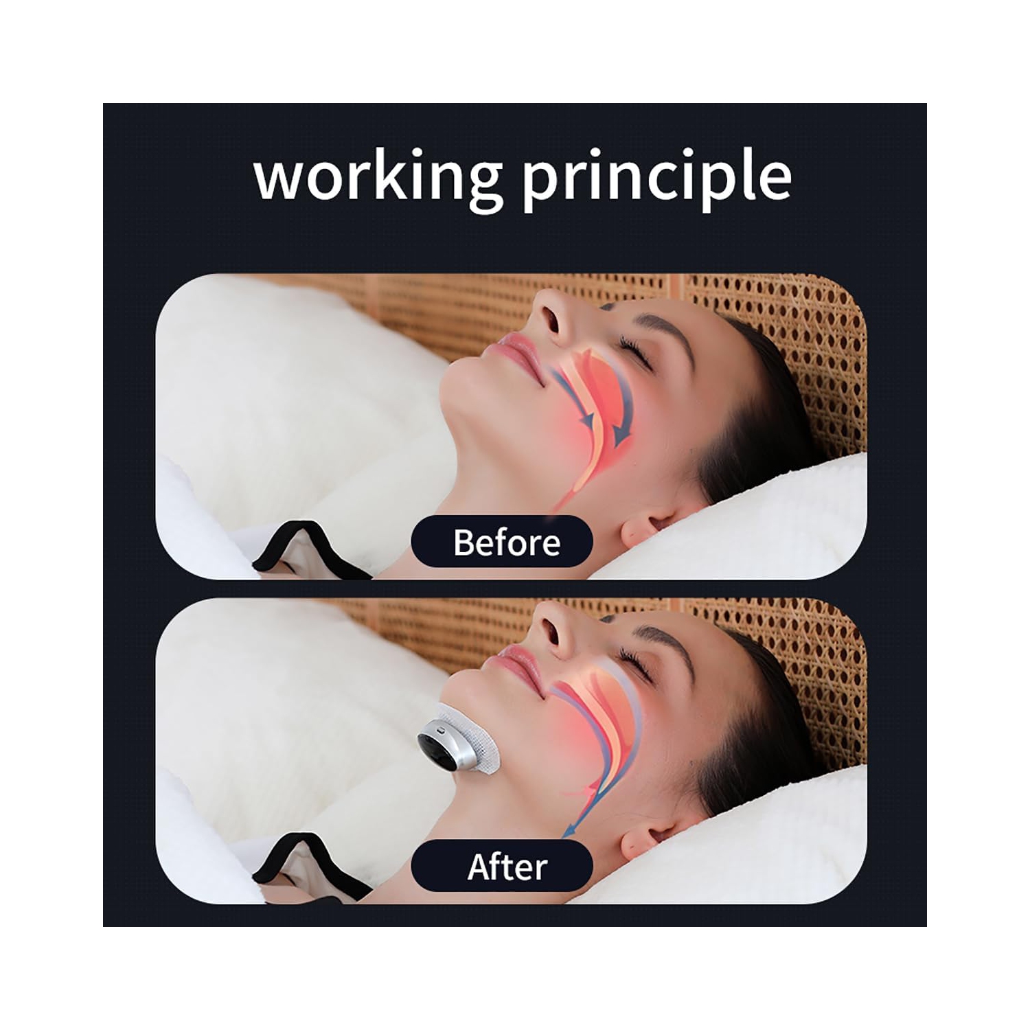 Dispositifs anti-ronflement électriques, haricot anti-ronflement électrique, appareil de sommeil ronflement adapté aux personnes ayant de la