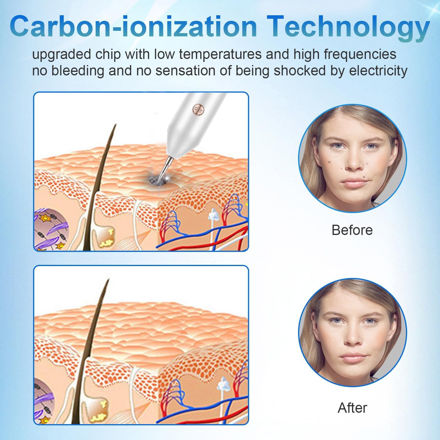 Stylo pour enlever les taches et les taches avec projecteur LED portatif rechargeable à 9 niveaux et outil dermatologique portatif pour la surface de