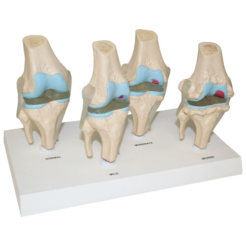 Walter Products 4 Stages of Disease Knee Joint Model