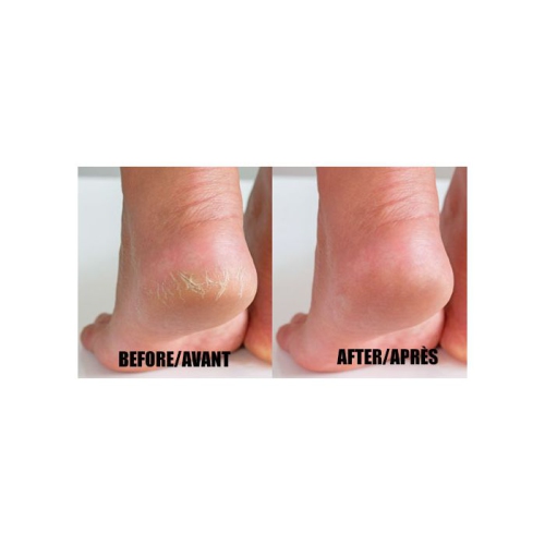 Dermaline PediGuard Callus remover