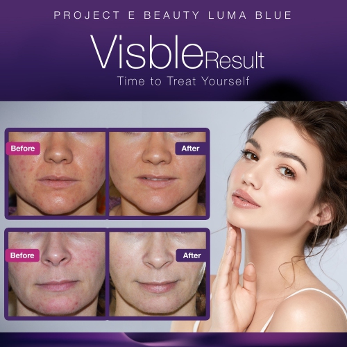 Project E Beauty LumaBlue | LED Light Therapy Cleansing Brush | Anti-Acne | Exfoliating Brush | Reduces Inflammation