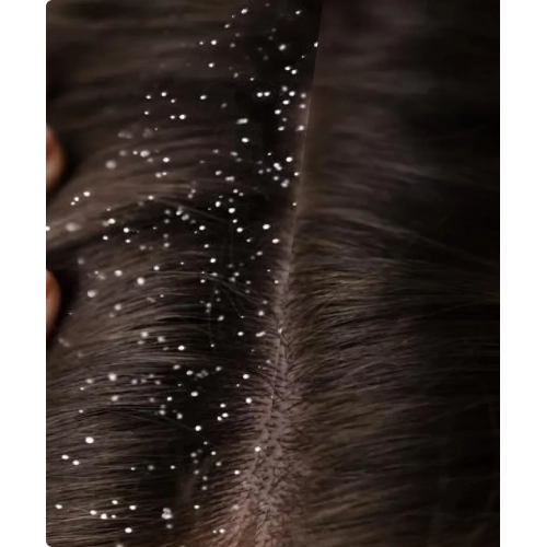 NuMe Dandruff Shampoo with Argan and Tea Tree Oil for Healthy Hair