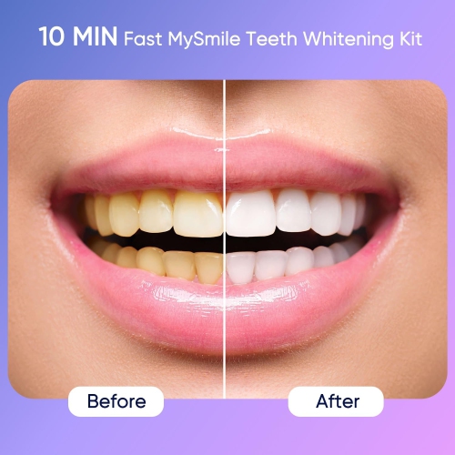 MySmile Deluxe 10 Min Teeth Whitening Kit with 28 LED Light, 35% Carbamide Peroxide Teeth Whitening Gel, Helps Remove Years of Stains from Coffee,