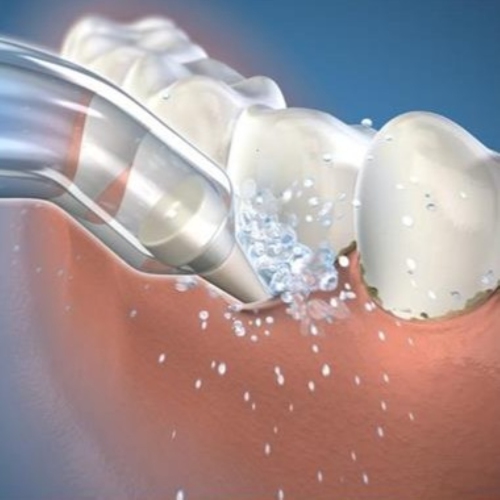 Embouts de poche Classic Pik de Waterpik - Paquet de 2