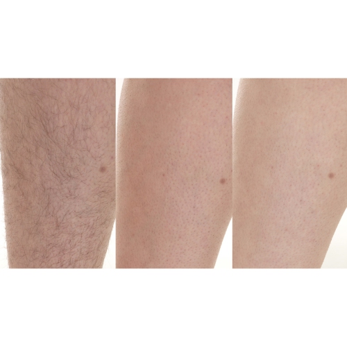 Silk'n Flash&Go Jewel Hair Removal Device