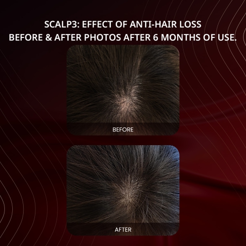 Breo Scalp3 Scalp Massager Comb Anti Hair Loss Scalp Massaging brush Hair Growth Care Scalp Hair Therapy Scalp Reduction Redlight Infrared Therapy