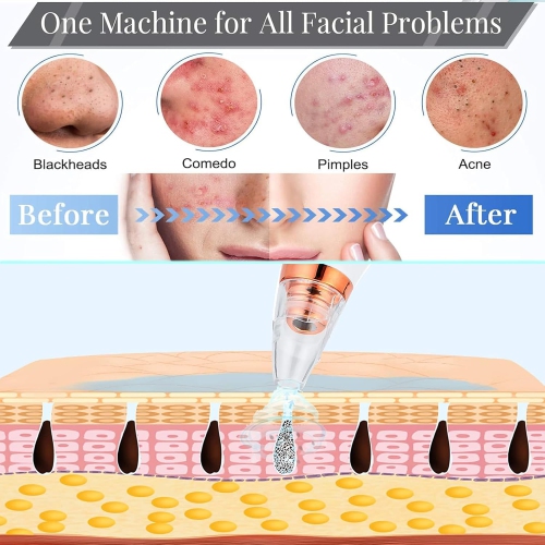 Blackhead Remover Vacuum,Black Head Remover for Face,Blackhead Extractor with 6 Suction Probes,USB Charging Pores Cleaning Vacuum for Women Men