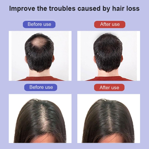 Casquette de thérapie de lumière rouge pour les cheveux, Thérapie de lumière rouge pour la perte de cheveux, Chapeau de soins de perte de cheveux