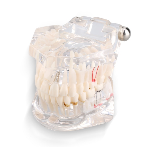 Image 1 de 9.. Étude d'enseignement des maladies dentaires Typodont Adulte Démonstration Modèle de dents Nouveau