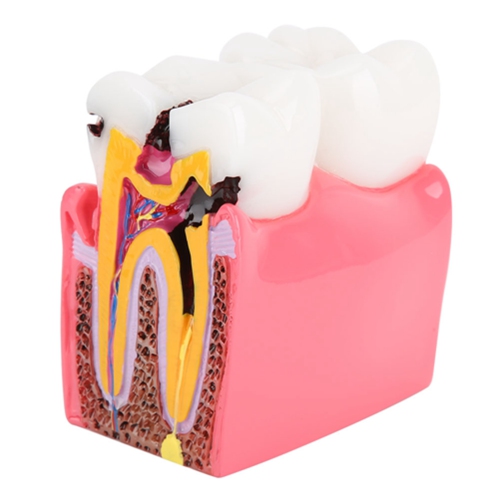 Image 1 de 9.. Caries Comparison Modèles d'étude Dentist Anatomy Dentist Dental Anatomy Education Modèle de dents