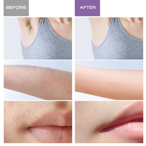 IPL Laser Permanent Portable Hair Removal Device Home Handle