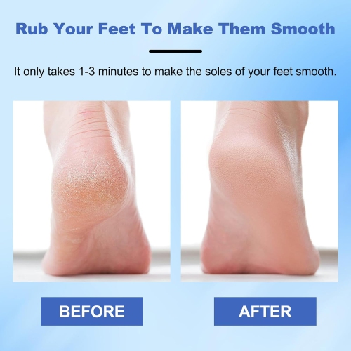 2PCS Hard Skin Remover Nano-Glass Foot File,Manual Foot File with Non-Slip Ergonomic Handle,Dry & Wet Use Foot Care Tool