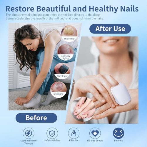 Nail Fungus Cleaning Light Device for Onychomycosis,Nail Fungus Light for Fingernails Toenails,Nail Fungus Remover