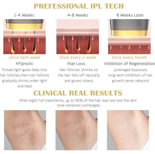 Laser Hair Removal Device Cold and painless technology, effective and long-lasting, can be used at home