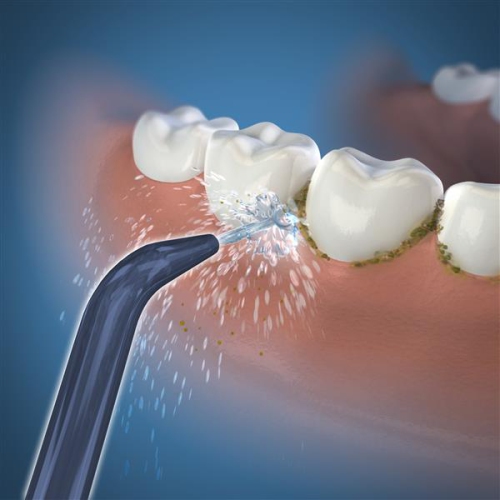 Pointes sans fil à basse pression Waterpik™ Classic - Paquet de 2