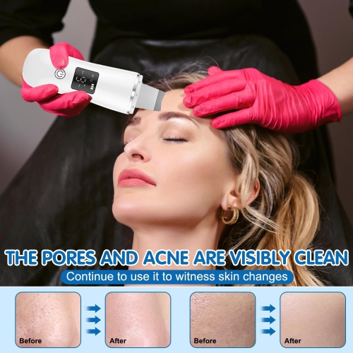 Face Scrubber Skin Spatula-2024 New Blackhead Remover Pore Cleaner,Pore Extractor Face Spatula Deep Cleaning for Facial Skin Care Women Gift(White)