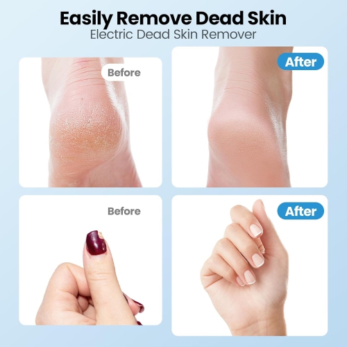 Electric Callus Remover for Feet,2 in 1 Electric Foot File Grinder,Rechargeable Cordless Foot Scrubber for Dead Skin,Adjustable Speed Professional