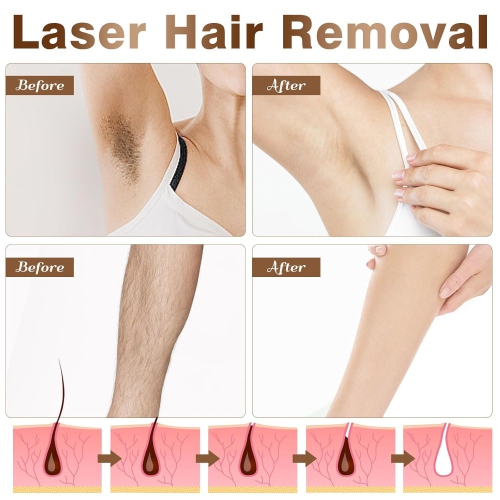 Laser Hair Removal for Women and Men, the permanent IPL Hair Removal device uses the latest rapid flash technology to remove hair from the face, legs