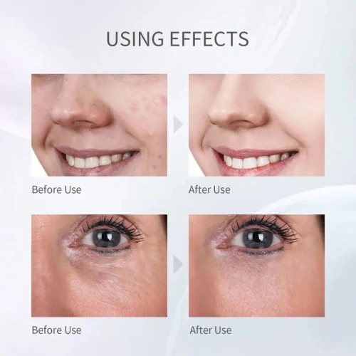 Nettoyant électrique pour le visage, grattoir à ultrasons pour la peau, instrument de beauté portatif et nettoyant pour les pores pour le nettoyage,