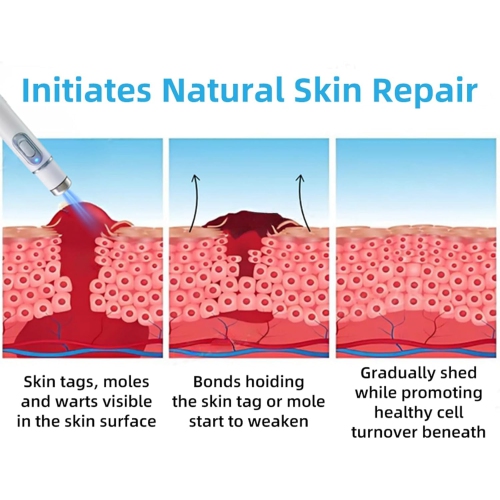 Paquet de 2 stylos pour enlever la tranche de la peau, décapant portatif la mole, tache foncée et stylo anti-acné pour les soins de la peau des femmes