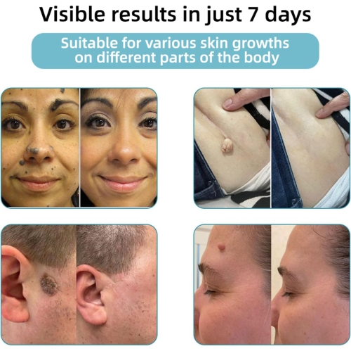 Paquet de 2 stylos pour enlever la tranche de la peau, décapant portatif la mole, tache foncée et stylo anti-acné pour les soins de la peau des femmes