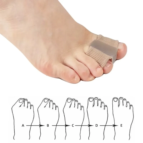 4 pièces de réglage de séparation à deux embouts en silicone Outil de correction efficace de raccord Hallux Valgus correcteur de raidisseur de