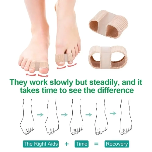 4 pièces de réglage de séparation à deux embouts en silicone Outil de correction efficace de raccord Hallux Valgus correcteur de raidisseur de