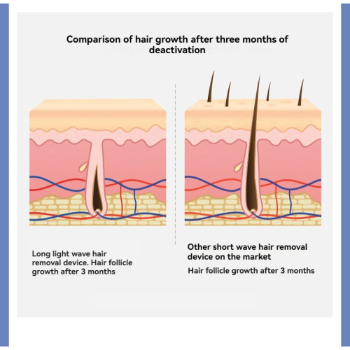 Intense pulsed light hair removal device, home electric laser hair removal device, unisex, 5-speed adjustable, painless, no dark spots, portable.